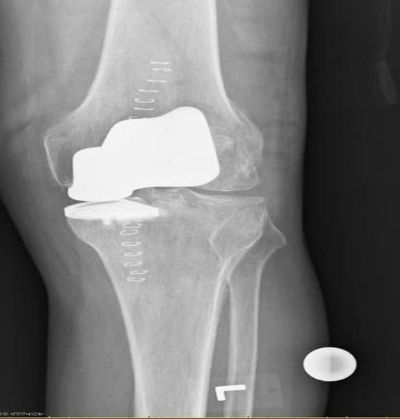 Knee Prostheses:  Bicompartmental:  Smith & Nephew Deuce (Implant 804)